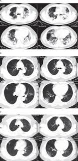 Prime time 20:00te cunosc de undeva! Clinical Features Of Patients Infected With 2019 Novel Coronavirus In Wuhan China The Lancet