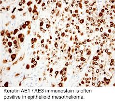 And at the japanese lung. Pathology Outlines Peritoneal Malignant Mesothelioma