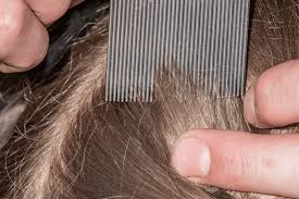 Image result for lice vs dandruff