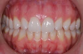 After you brush, floss at least once a day in between each tooth to get rid of any leftover bacteria. Periodontal Specialist Gum Disease Specialist Cotswold Periodontal Centre Check Your Gums