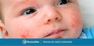 Sintomas De La Alergia A Las Proteinas De Leche De Vaca Y Diagnostico