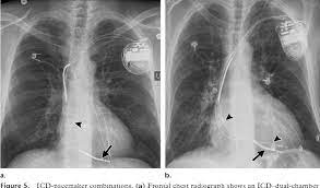 Icds are best distinguished from pacemakers on cxr by coils that appear as thickened icd vs pacemaker. Figure 5 From Radiography Of Cardiac Conduction Devices A Comprehensive Review Semantic Scholar