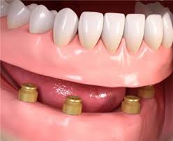 The pressure from your denture will help to reduce bleeding and swelling. Dentures In South East London Accepting New Nhs Patients