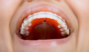 Check spelling or type a new query. The Braces Are Off Now How Long Do You Have To Wear A Retainer Myorthodontist