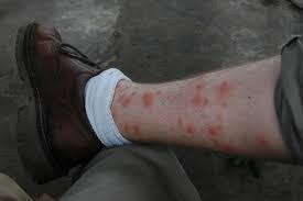 Image result for Trombicula autumnalis bites