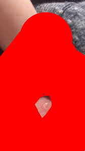 An ingrown hair or razor rash is usually a harmless skin infection resulting from removing hair around the genitals. Std Ingrown Hair Glow Community