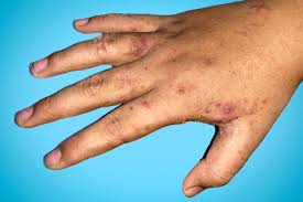 Image result for scabies symptoms