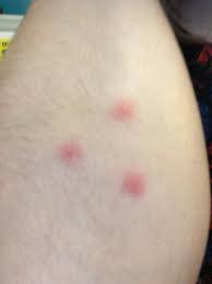 Quick facts on flea bites. 3 Dots Bite Novocom Top