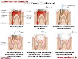 Rotary Endodontics Course Root Canal Treatment Root Canal Treatment Poster Root Canal