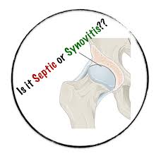 Image result for Septic Joint
