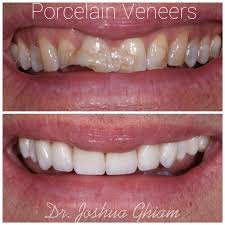 Generally, most veneers, including lumineers and da vinci veneers are also in that price range. Cost Of Dental Veneers Los Angeles Porcelain Veneers Los Angeles