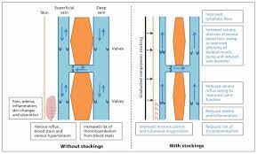 Graduated Compression Stockings Cmaj