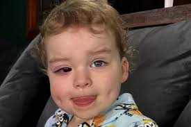 Scots toddler left blind after bumping head while learning to walk