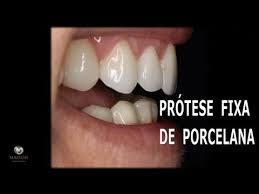 Protese Fixa De Porcelana Com Implantes Youtube