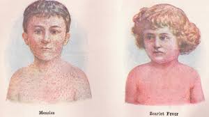 Image result for Scarlet Fever