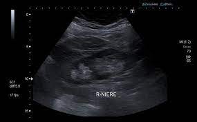 Duplex Collecting System Radiology Case Radiopaedia Org