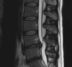 Image result for vyhřezlá ploténka