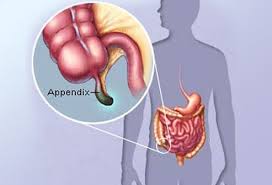 Appendicitis Symptoms Signs Causes Appendectomy In Detail