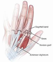 Image result for Elson Extensor Tendon Test