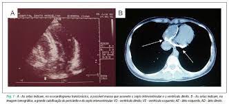 A pericardite constritiva é uma inflamação crônica ou de longo prazo do pericárdio. Scielo Brasil Pericardite Constritiva Com Calcificacao Extensa Pericardite Constritiva Com Calcificacao Extensa