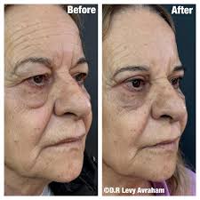 דר לוי אברהם‎ (@dr_levy_avraham) • Instagram photos and videos