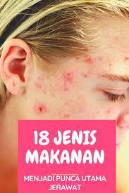 18 Jenis Makanan Yang Menjadi Punca Jerawat Susah Hilang Skin Care Routine Rosacea Rosacea Redness