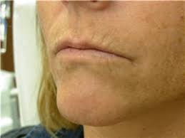 Welcome to bellissima aesthetics & wellness center, where we specialize in offering quality and holistic aesthetic treatments for men and women. Bellissima Medical Aesthetics Dieppe Nb 6 855 Boul Dieppe Canpages