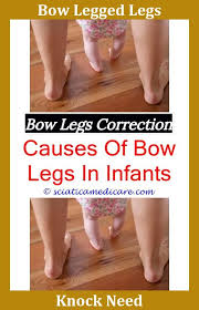 What Causes Bow Legs Bow Legged Correction Bow Legged Knock Knees