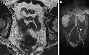 Pelvic Congestion Syndrome The Role Of Interventional Radiology In The Treatment Of Chronic Pelvic Pain Postgraduate Medical Journal