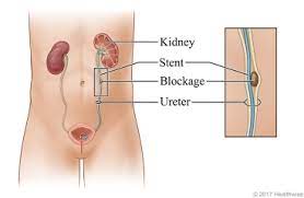 Ureteral Stent Removal What To Expect At Home