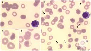Image result for G6PD Deficiency Detection