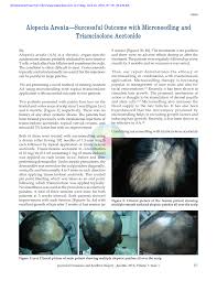 You must understand the concept, 'needling promotes skin. Pdf Alopecia Areata Successful Outcome With Microneedling And Triamcinolone Acetonide