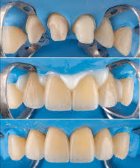 In the past decades, dentistry (and aesthetics in particular) has undergone an evolution. Dentagama On Twitter Crowns Cementation Under Rubber Dam