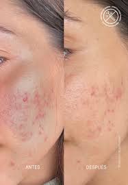 Image result for Azelaic Acid