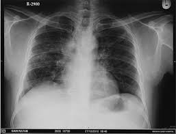 Chest X Ray Showing Reticulonodular Opacities In The Both The Lung Download Scientific Diagram