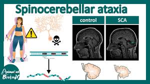 Image result for Ataxia