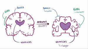 Includes causes, symptoms, and how progressive supranuclear palsy is treated. Pin On Pain Management Addiction And Options