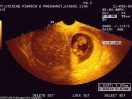Maybe you would like to learn more about one of these? Fibroids Pregnancy Fibroid Treatment Collaborative