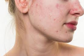 Sama halnya seperti toner air beras, masker kunyit berfungsi untuk menghilangkan noda gelap bekas jerawat. Menghilangkan Jerawat Membandel Yang Tidak Kunjung Sembuh Eva Mulia Clinic