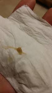 Am o secretie vaginala care ma cam ingrijoreaza. Lichid Maro Inchis DescÄƒrcarea De Maro La Femei Motivele Scurgere VaginalÄƒ Maro Inchis Tratament