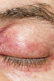 There are several different factors to consider, both internally and externally. Eyelid Dermatitis Treatment Symptoms And Causes