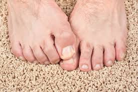 Image result for Yellow nail syndrome feet