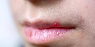 How to know if a lip pimple is just a pimple — so you can zap it, fast. Pimple On Lip Causes Treatment And Prevention