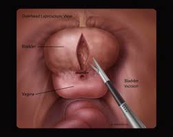 A bronchopleural fistula is a serious side complication often caused by lung cancer surgery. Laparoscopic And Robotic Assisted Vesicovaginal Fistula Repair A Systematic Review Of The Literature Sciencedirect
