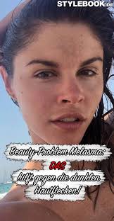 Wie Beugt Frau Dunklen Pigmentflecken Im Gesicht Vor Stylebook Pigmentflecken Gesicht Pigmentflecken Gesicht