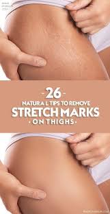 How To Get Rid Of Stretch Marks Fast And Naturally With Images Stretch Marks Stretch Mark Removal Stretch Marks On Legs