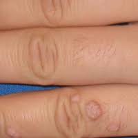 Die häufigsten formen sind stachelwarzen, mosaikwarzen, dornwarzen. Dermatologie Dermatologie Dr Fritsch Dusseldorf