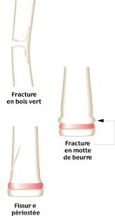 Les Pathologies Du Football Chez L Enfant Club Football Fc Saint Andre De Cubzac Footeo