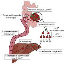 Adopting a diet that is low in fat and high in fiber, fruits, and vegetables does not influence the risk of recurrence of colorectal the question whether dietary fiber contributes to colorectal cancer has (at least for me) been answered time and again—yes, it absolutely does. Plasticity Of Lgr5 Negative Cancer Cells Drives Metastasis In Colorectal Cancer Sciencedirect