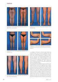 Lipodem Rosenfluh Ch
